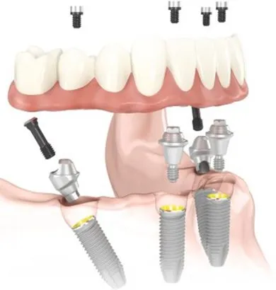 Diagram of All-on-4 dental implants with back implants angled to provide support for dentures, from Oral Surgery Associates & Dental Implant Centers of Atlanta.