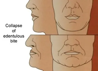 Diagram of collapse of an endentulous bite, Oral Surgery Associates & Dental Implant Centers of Atlanta, GA.