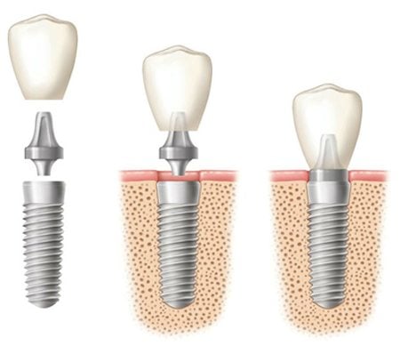 Diagram of three phases of a dental implant, before, during, and after placement, for information on bone grafting from Oral Surgery Associates & Dental Implant Centers.