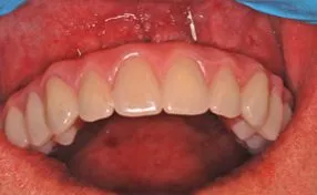 After close-up photo of upper teeth that were replaced with Teeth-in-a-Day from Oral Surgery Associates and Dental Implant Centers of Atlanta, GA.