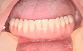 After close-up photo of lower teeth that were replaced with Teeth-in-a-Day from Oral Surgery Associates and Dental Implant Centers of Atlanta, GA.