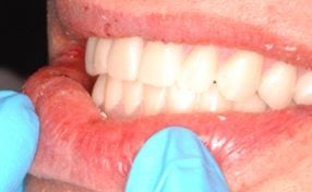 After close-up profile photo of teeth that were replaced using Teeth-in-a-Day from Oral Surgery Associates and Dental Implant Centers of Atlanta, GA.