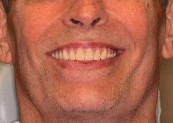 Nose-and-mouth after photo for Teeth in a Day from Oral Surgery Associates and Dental Implant Centers of Atlanta, GA.