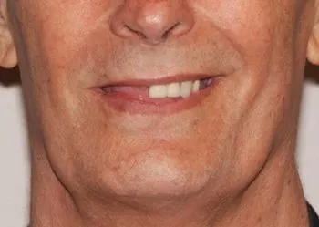 Nose-and-mouth before photo for Teeth in a Day from Oral Surgery Associates and Dental Implant Centers of Atlanta, GA.