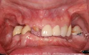 Before close-up photo of missing teeth, for information on Teeth-in-a-Day from Oral Surgery Associates and Dental Implant Centers of Atlanta, GA.