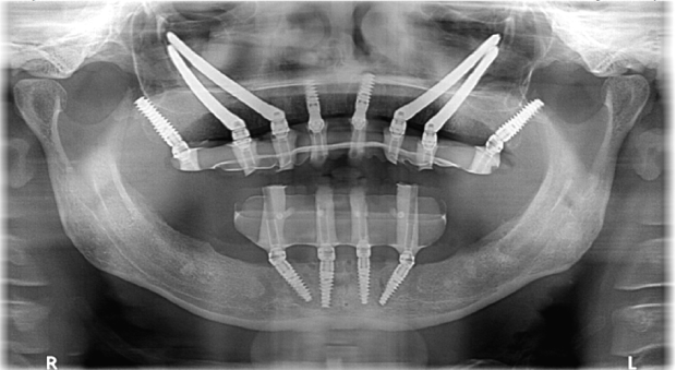 Xray image of dental implants